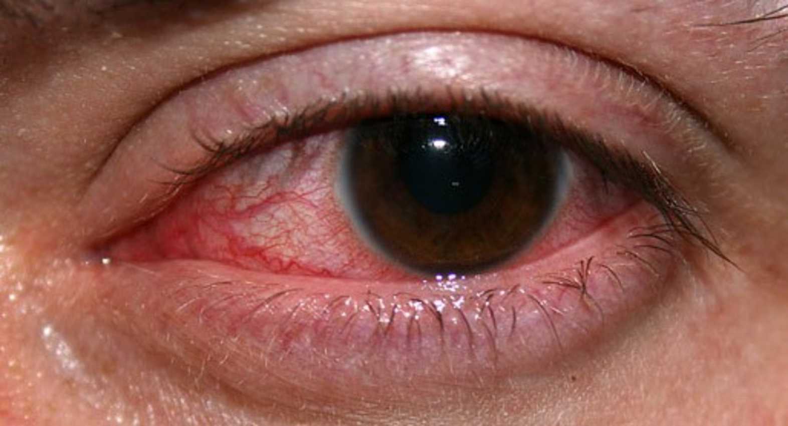 Antifungal Eye Drop List For Manufacturing & Franchise