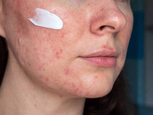 Top 10 Metronidazole Cream Brands in India
