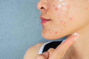 Top 10 Clindamycin Nicotinamide Cream Brands in India